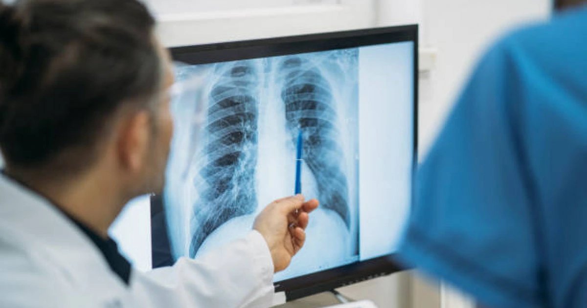 Kazakhstan lung cancer screening finds 39 suspected cases among 914 scanned