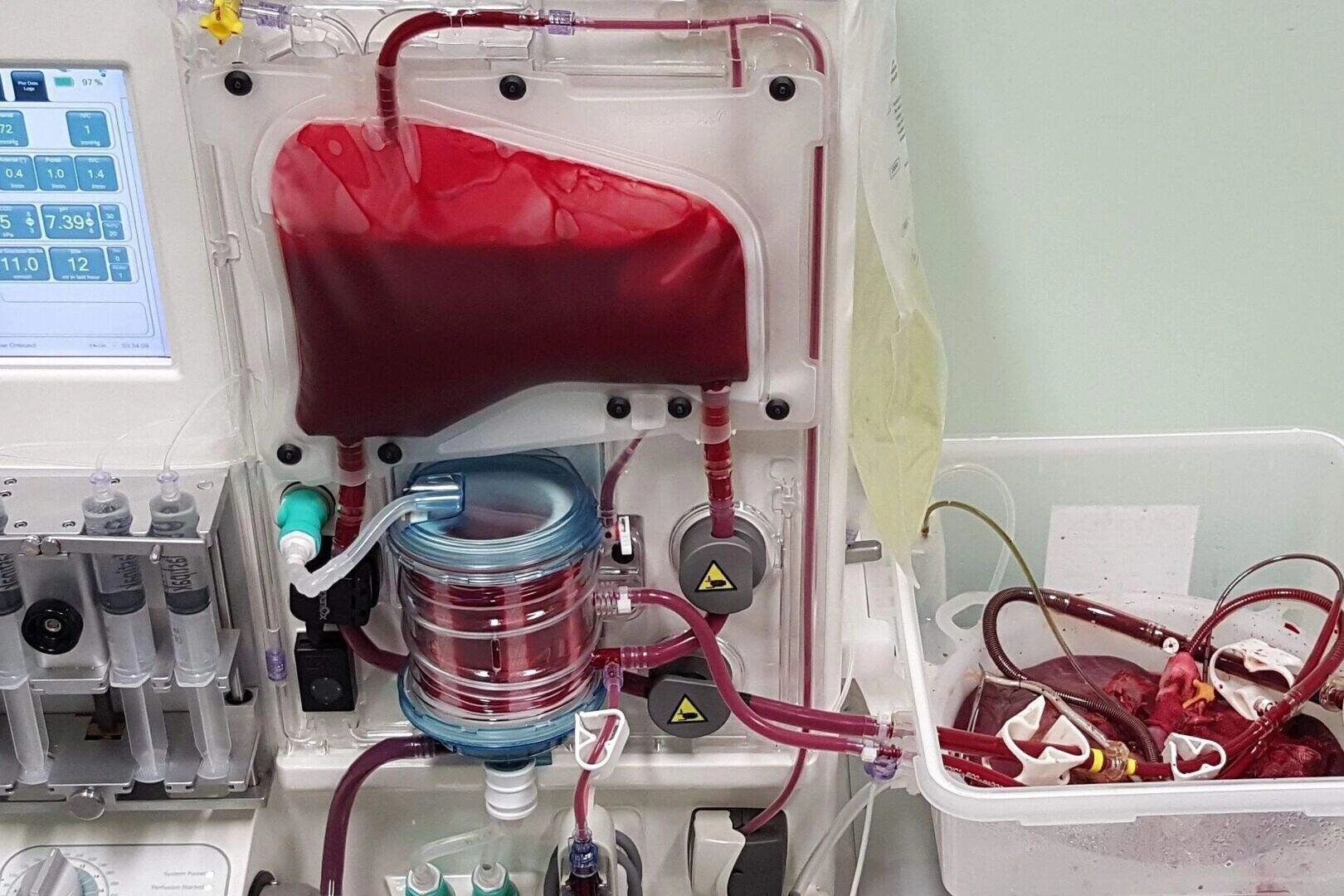 Donated livers get biologically younger on perfusion machines, study finds